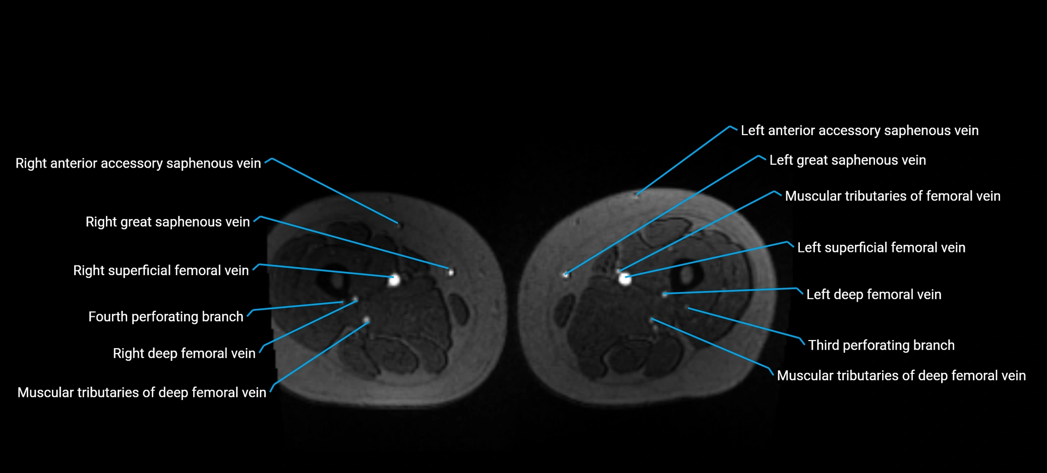MRV abdomen pelvis & lower limb axial cross sectional anatomy labelled MRI image 268 (1).webp